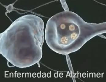Alzheimer